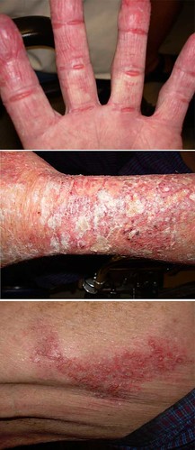 Allergic contact dermatitis (neomycin)