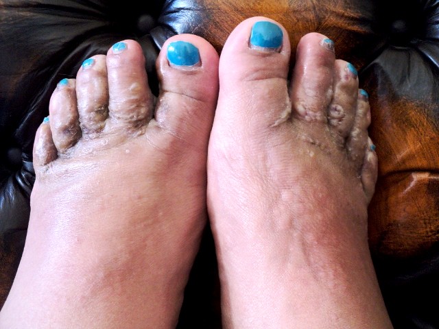 foot bacteria