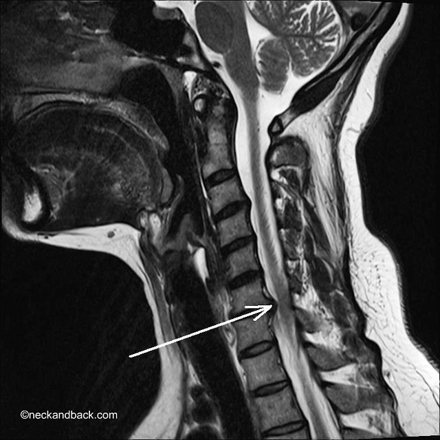 Lateral Cervical MRI of Disc Herniation | Dr Donald ... cns diagram 