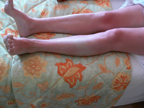 gambe scottate di ragazza stesa sul letto