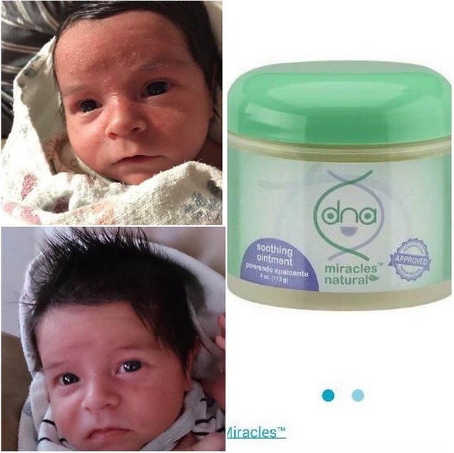  before and after results of baby forehead using DNA Miracles Soothing Ointment