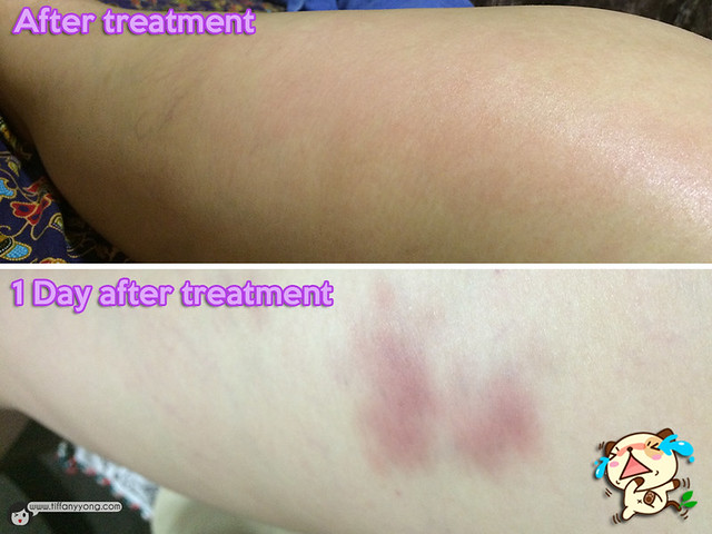 Annabelle Skin After CBV Treatment