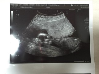 エコー写真　妊娠５ヵ月