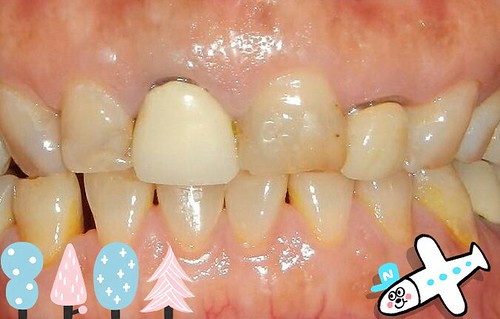 白牙萬事順，一切都要從到人本自然牙醫做牙齒美白陶瓷貼片說起_0308_01 (3)