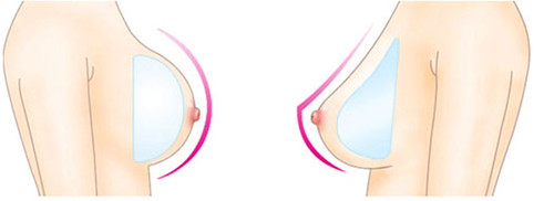 8_美妍醫美水滴隆乳--圓與水滴胸型示意圖2