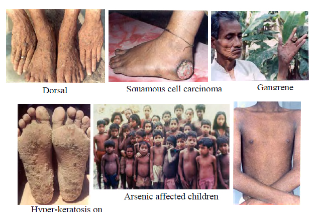 Arsenic affected of west bengal