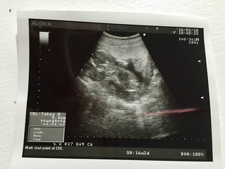 妊娠5ヵ月　エコー写真