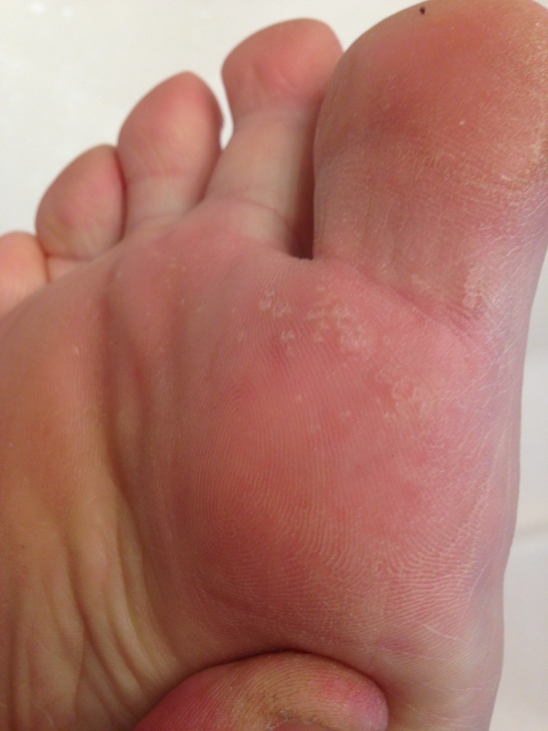 Red Itchy Bumps On The Bottom Of My Foot