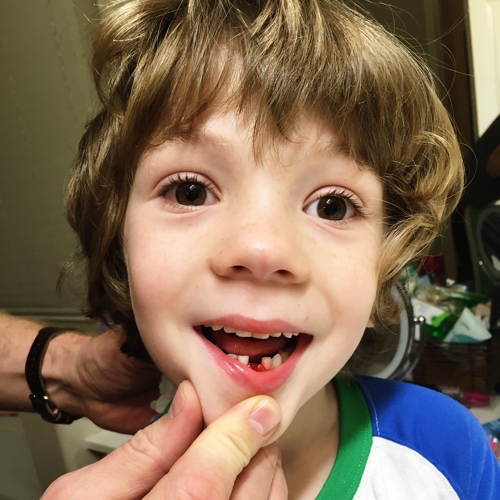 Lost first tooth