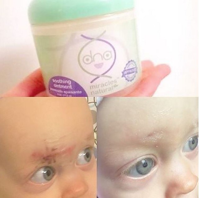  before and after results of baby ezcema using DNA Miracles Soothing Ointment