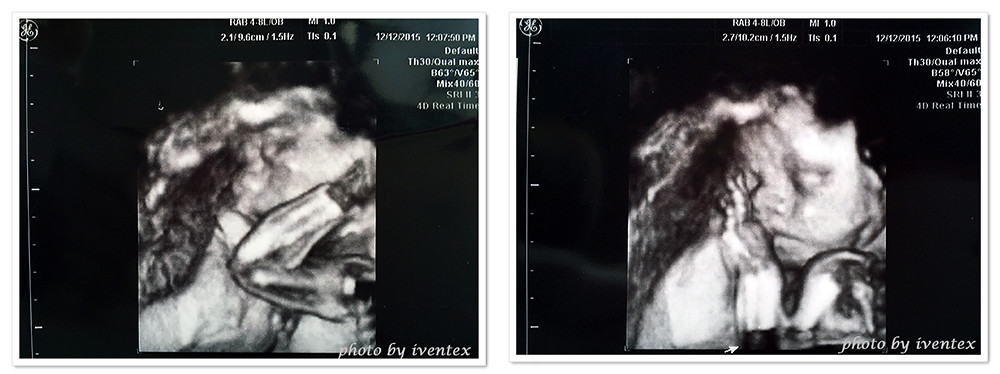 21-22刀口力懷孕第24週超音波20151212