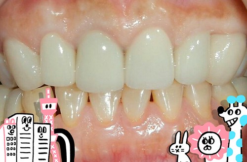 白牙萬事順，一切都要從到人本自然牙醫做牙齒美白陶瓷貼片說起_0308_01 (4)