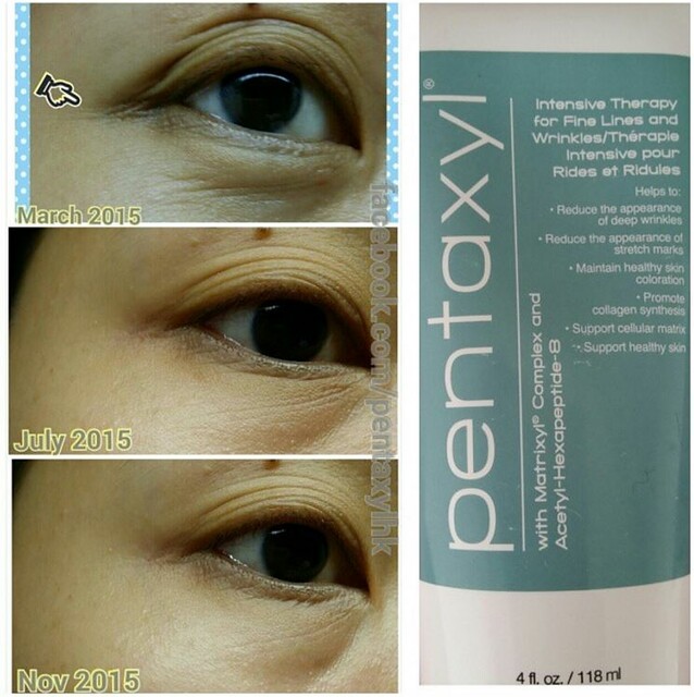  Before and after results of Pentaxyl - crow's feet