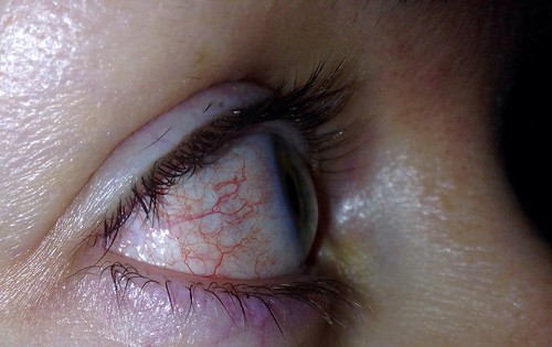Eyeballs are still zombified