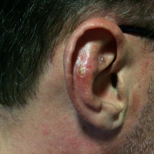 skin cancer surgery required to remove BCC on ear