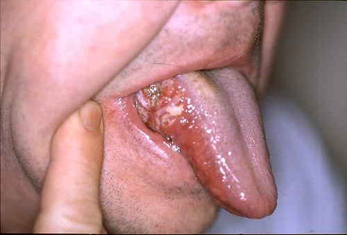 How To Cure Canker Sore On Tongue