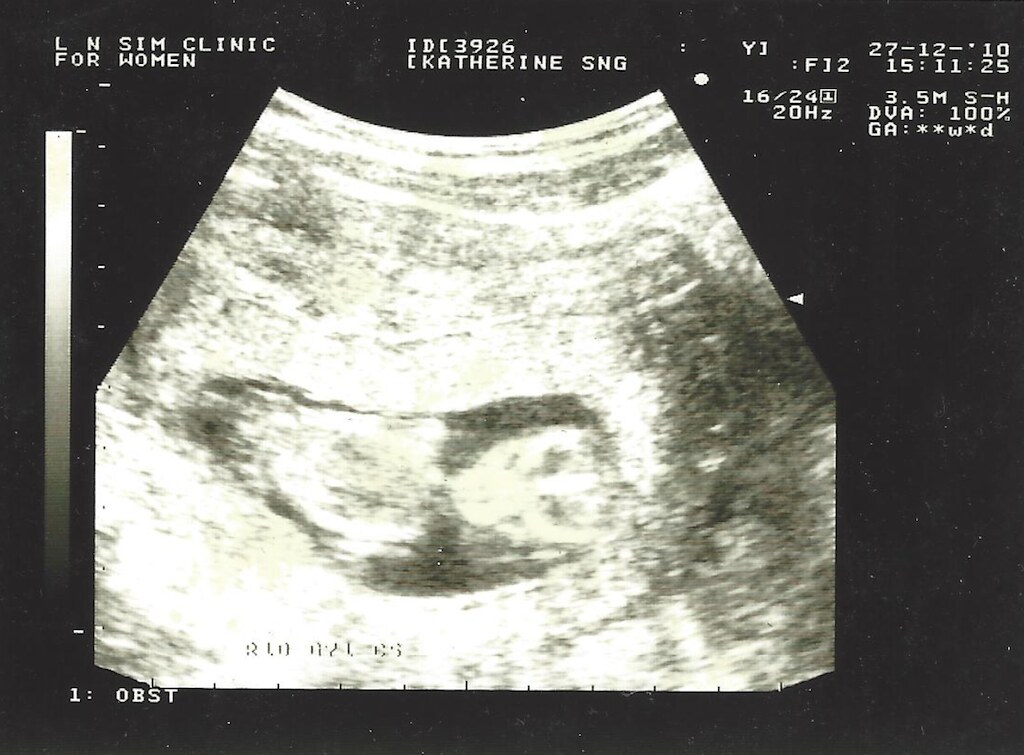 flying_solo_baby_scan