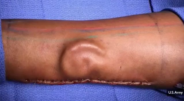 Army Doctors Grew a Soldier a New Ear — On Her Forearm