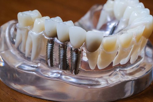 高雄前鎮人本自然牙醫施昆育醫師分享：植牙前不能忽略兩大關鍵