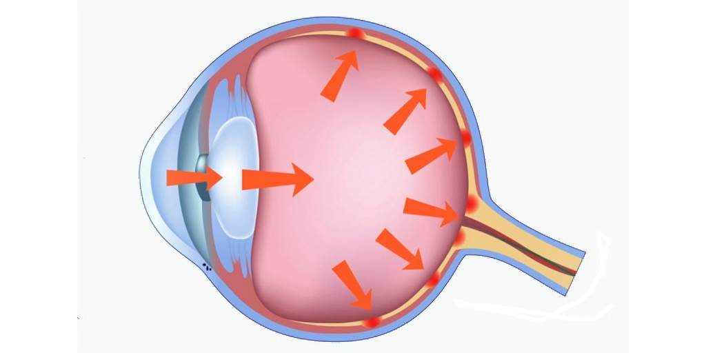 yeux-glaucome-implant-sans-fil-pression-prévention-caltech