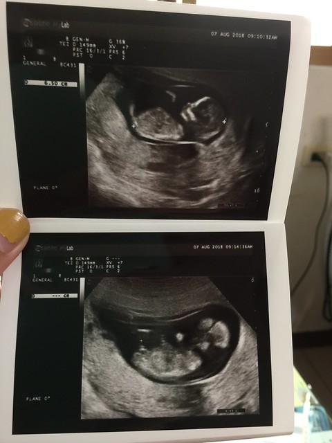 14周胎儿图片 真实图片