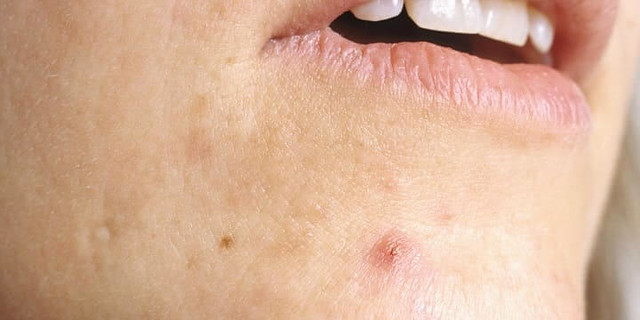 4638 6 reasons you should not pop pimples on your face 04